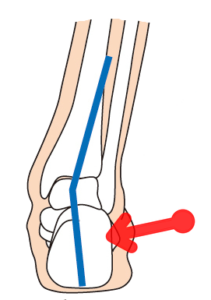 膝の痛み 原因